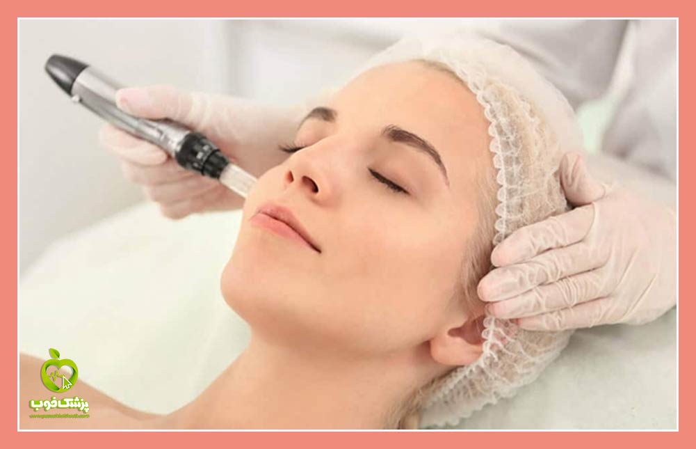 microneedling میکرونیدلینگ