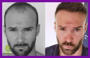 Hair transplantation